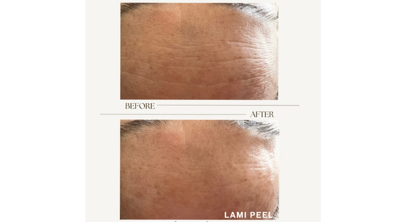 lami peel glass skin facial newcastle